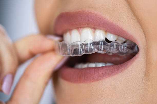 Clear and Convenient- Why You Should Choose Invisalign